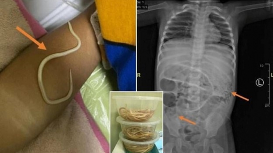 Bé trai tắc ruột vì giun làm ổ trong bụng, bác sĩ khuyên phụ huynh đừng chủ quan