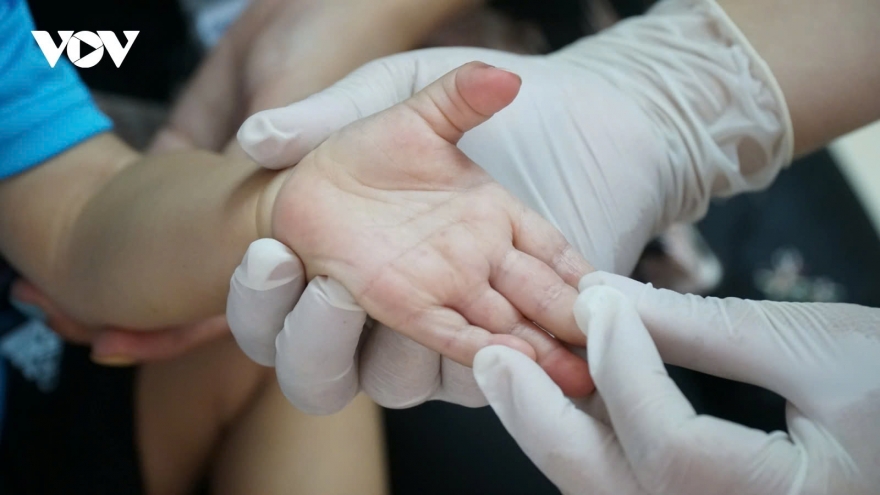 Cẩn trọng với bệnh tay chân miệng khi thời tiết chuyển mùa