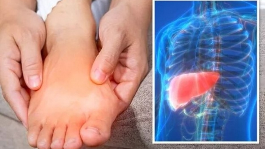 5 dấu hiệu cảnh báo xơ gan hay xuất hiện ở chân nhưng ít người biết