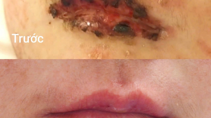 Tự mua thuốc cảm uống, nữ bệnh nhân nhập viện vì hội chứng hoại tử da