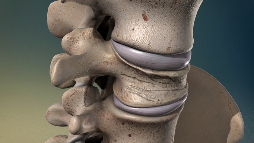 Chăm sóc bệnh nhân sau khi thực hiện bơm xi măng cột sống