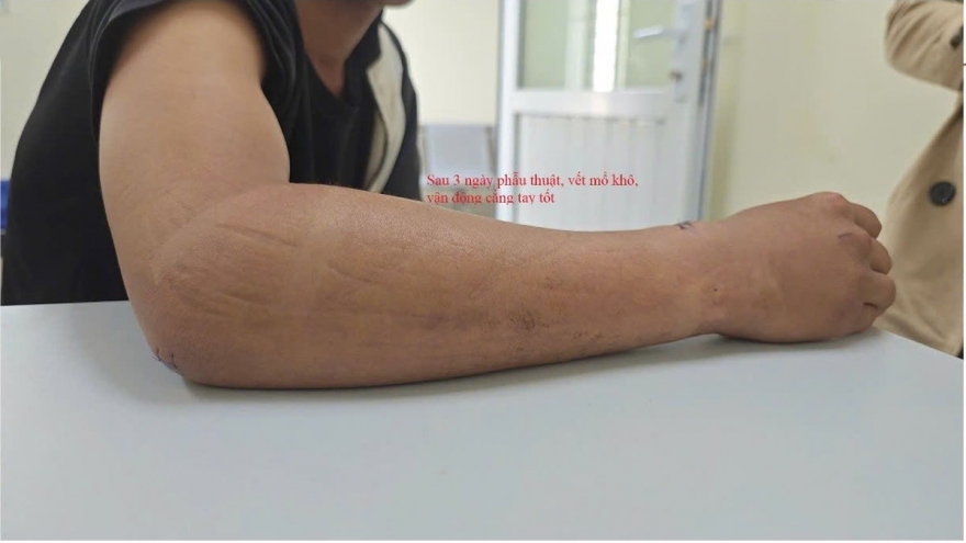 Sơn La điều trị gãy kín thân 2 xương cẳng tay bằng kỹ thuật đóng đinh Metaizeau