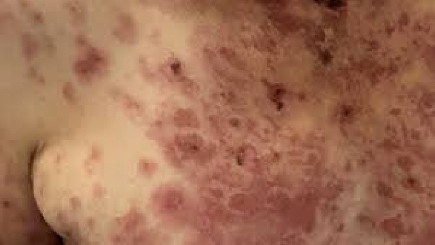 Bất thường ở da, cảnh báo một số bệnh lý nguy hiểm