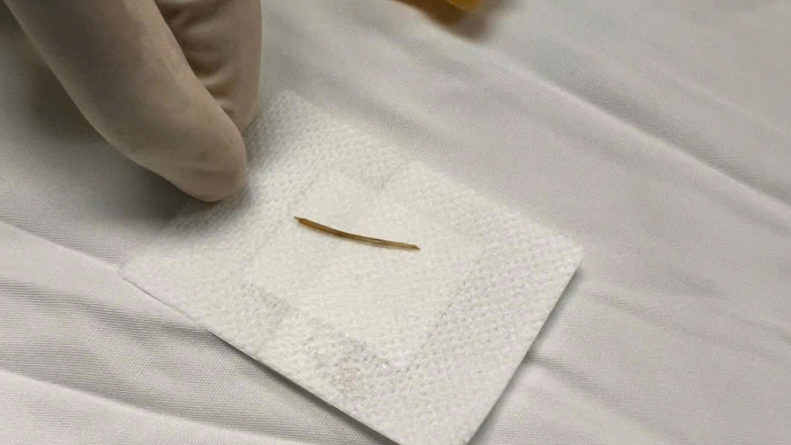 Phẫu thuật thành công cho bé trai 2 tuổi do nuốt phải xương cá