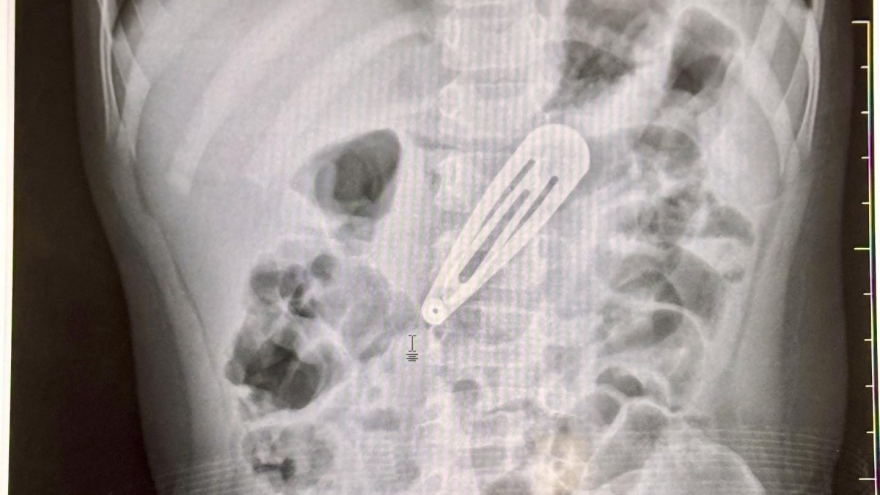 Dị vật là kẹp tóc dài 5cm trong dạ dày bé gái 21 tháng tuổi