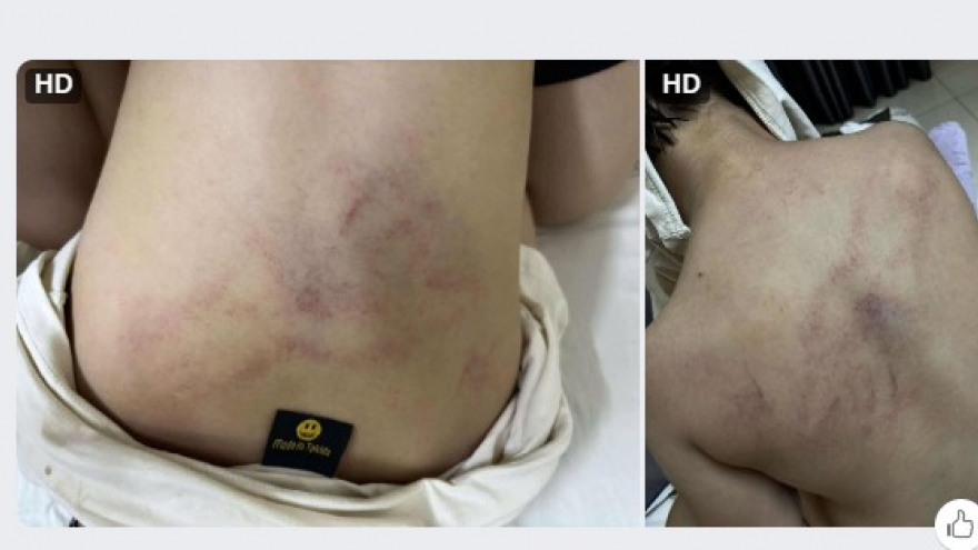 Bé 4 tuổi ở Hà Nội vào viện khám vì nghi bị giáo viên đánh đập