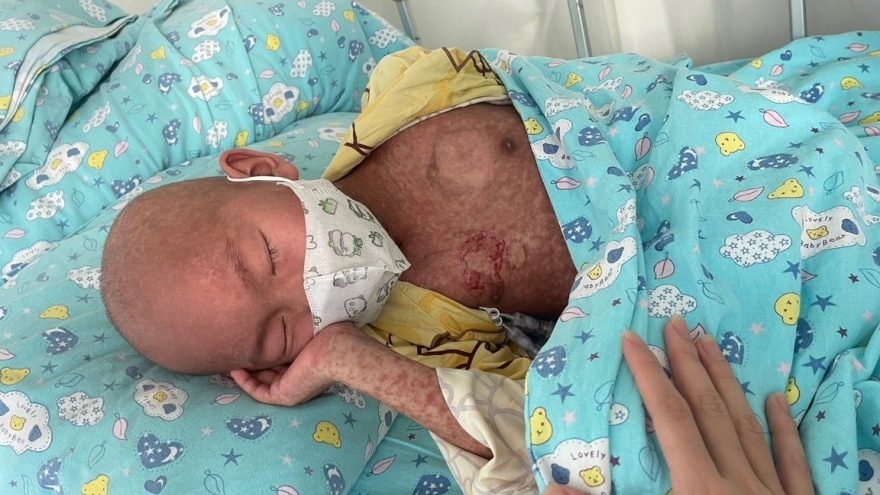 Xót xa bé 8 tuổi sau ghép tủy đối mặt với biến chứng nguy hiểm đến tính mạng