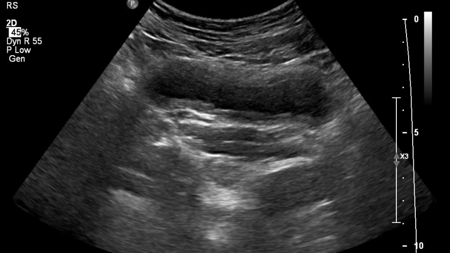 Cảnh báo viêm đường tiết niệu mùa hè: 3 sai lầm khiến bệnh dễ tái phát nặng