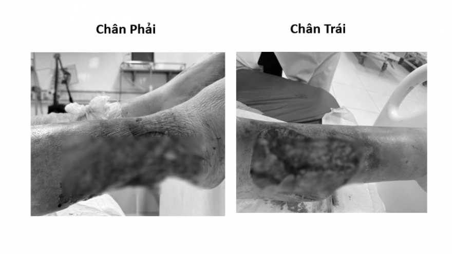 Cảnh báo nguy cơ hoại tử ở bệnh nhân đái tháo đường sau chấn thương nhỏ
