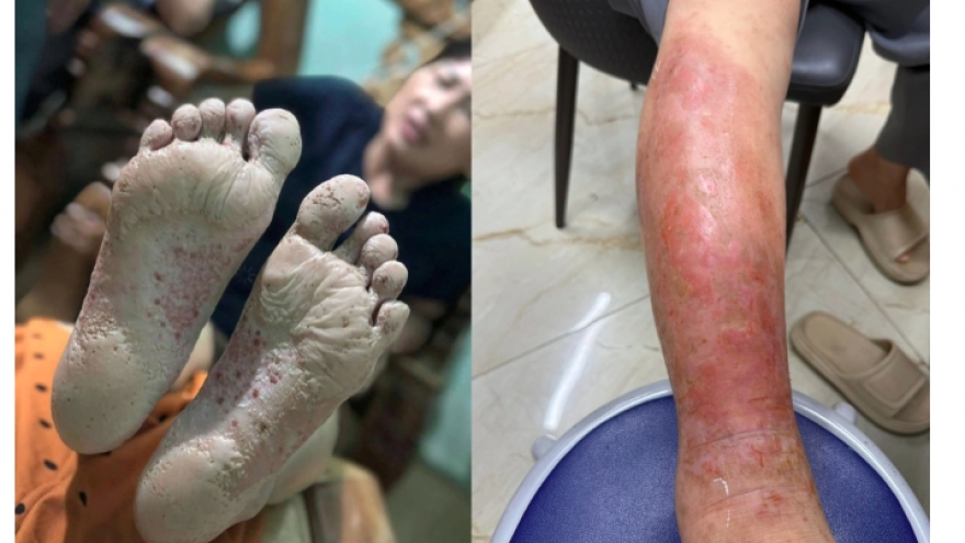 Hàng loạt bệnh rình rập sau mưa bão: Làm gì để tự bảo vệ?