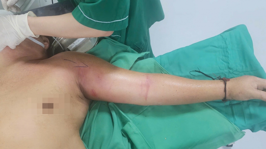Nhiễm trùng nặng vì tự tiêm mật gấu vào tay để chữa đau ngực
