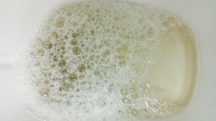 Tiểu ra bọt có phải dấu hiệu bệnh lý đáng lo lắng?