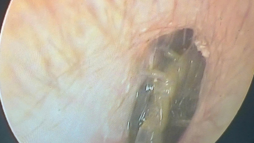 Nam bệnh nhân nhập viện vì rết chui vào tai khi đang ngủ