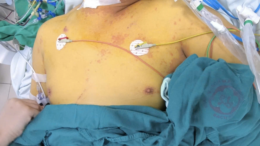 Liên tiếp ca nhiễm khuẩn Leptospira nặng sau bão số 10, 11