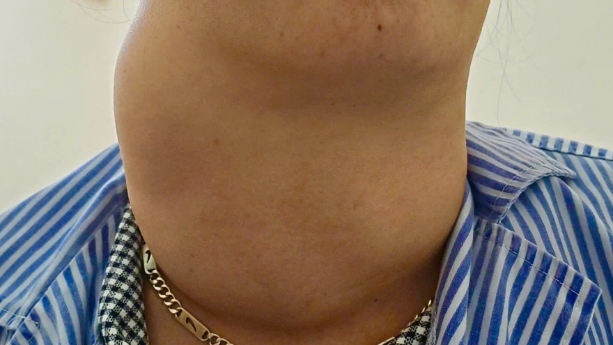 Cảnh báo từ ca bướu giáp khổng lồ ở bệnh nhân 41 tuổi