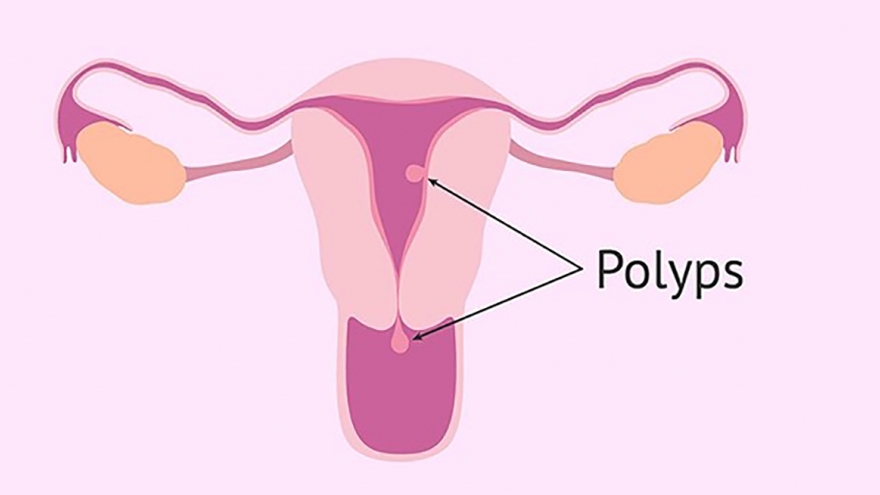 Từ ca mất máu nghiêm trọng vì polyp buồng tử cung, bác sĩ cảnh báo tới bạn gái trẻ