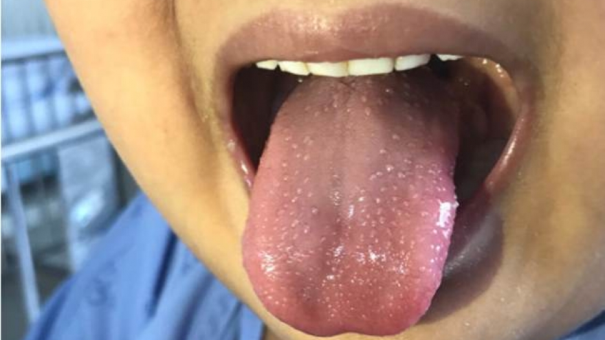 Mỹ xác nhận 38 trẻ em mắc hội chứng viêm hiếm gặp nghi do virus Sars-CoV-2