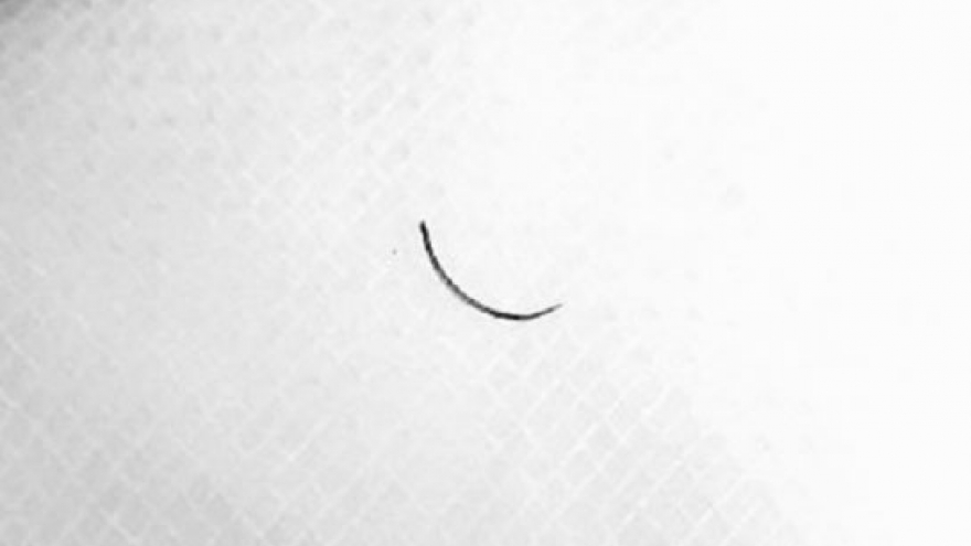 Hy hữu: Kim khâu năm trong mí mắt một phụ nữ hơn 2 năm