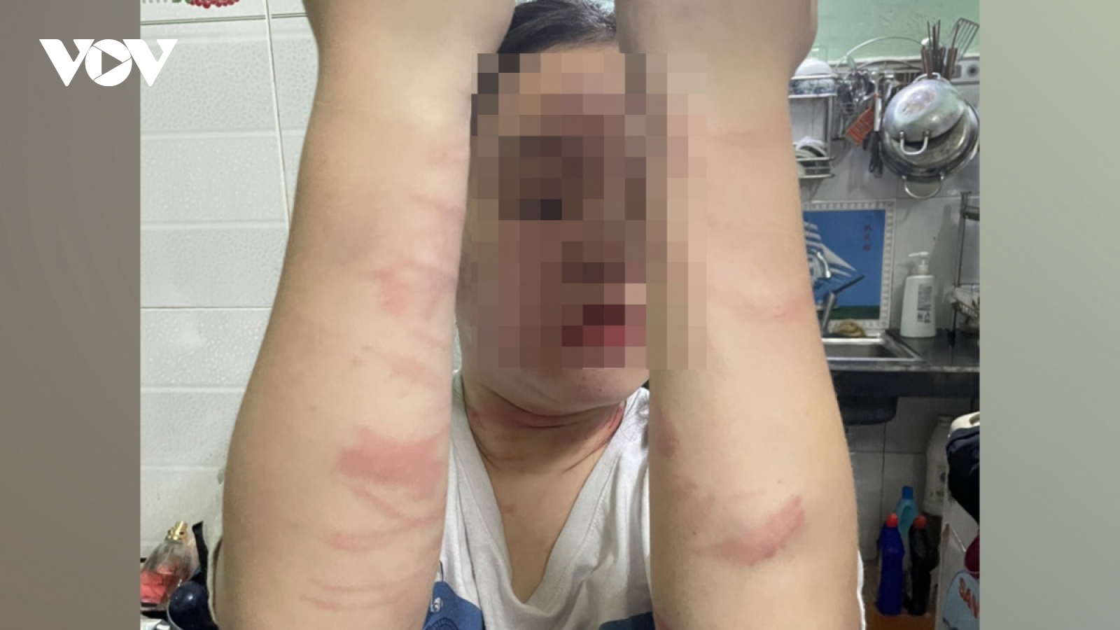 Nóng 24h: Nữ sinh 17 tuổi nghi bị mẹ đánh thương tích vì “hỗn”