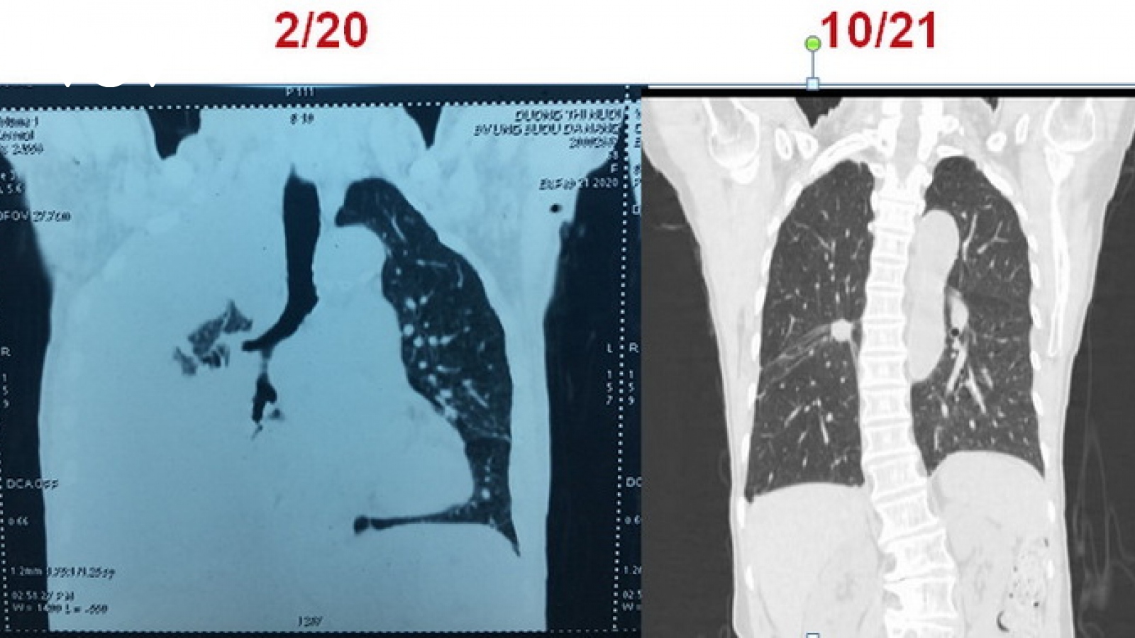 Sử dụng hiệu quả thuốc nhắm trúng đích EGFR-TKI thế hệ 3 cho bệnh ung thư phổi