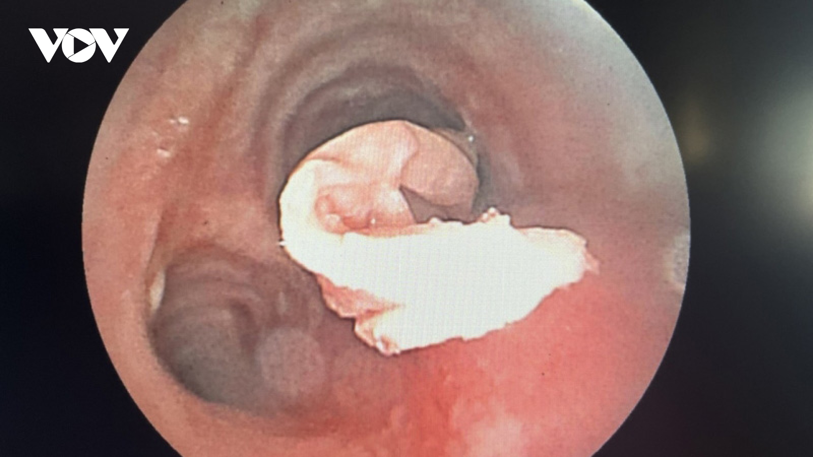 Dị vật khăn giấy trong phế quản bệnh nhân ung thư