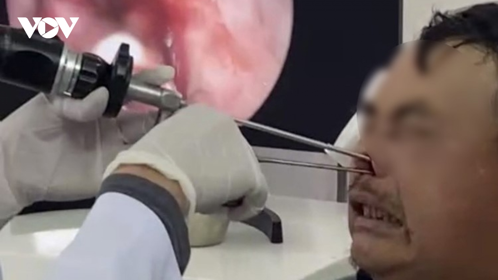 Nam bệnh nhân ở Lào Cai phải cấp cứu với hơn 100 con giòi trong hốc mũi