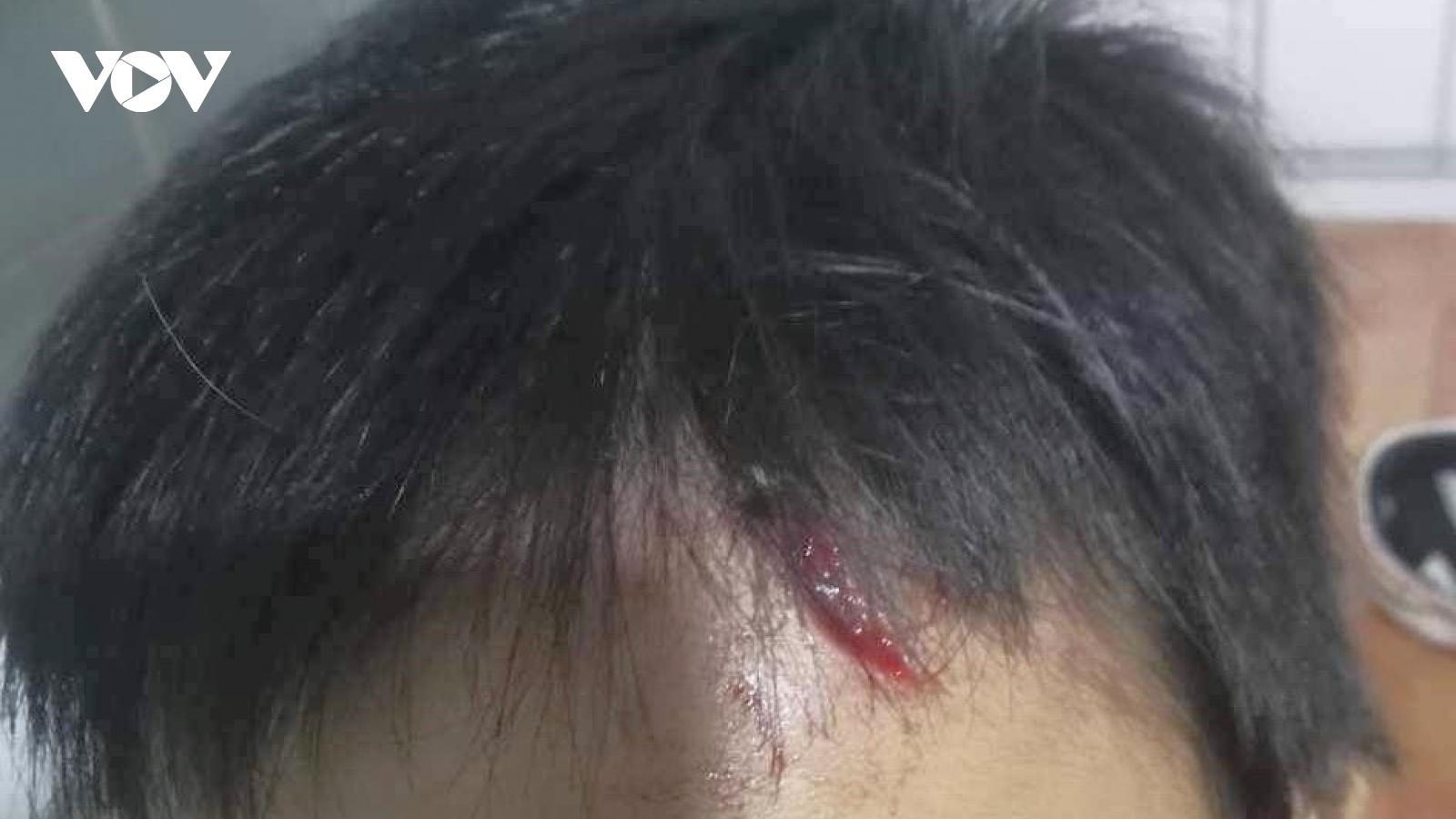 Công an vào cuộc vụ cháu bé từng bị hành hạ lại bị bầm mình, rách đầu