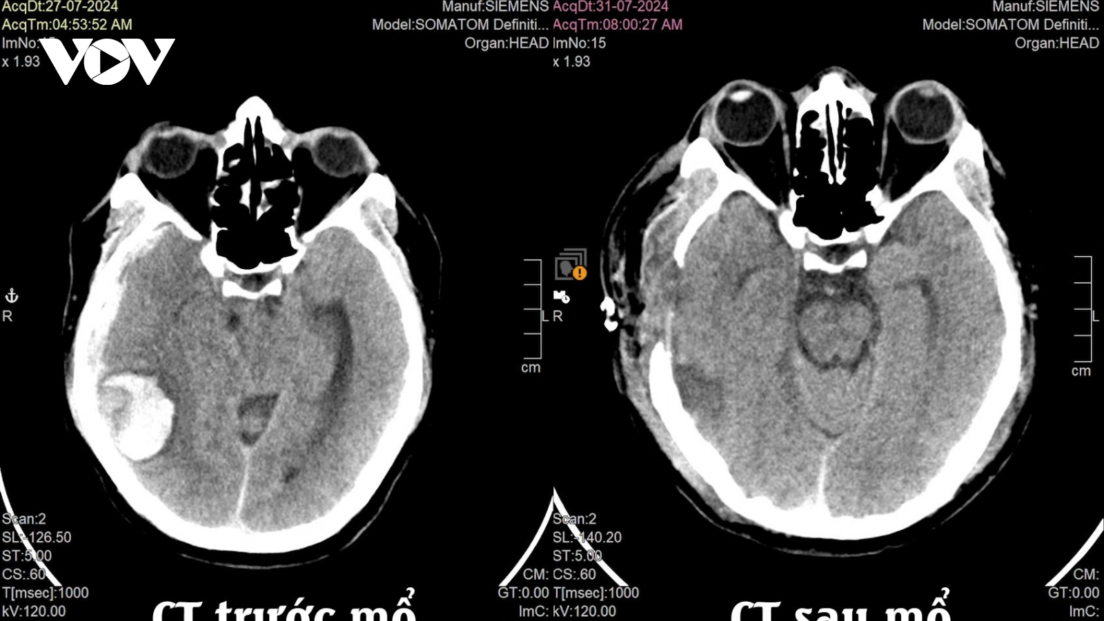 Hồi phục ngoạn mục sau phẫu thuật mạch máu não dị dạng hiếm gặp