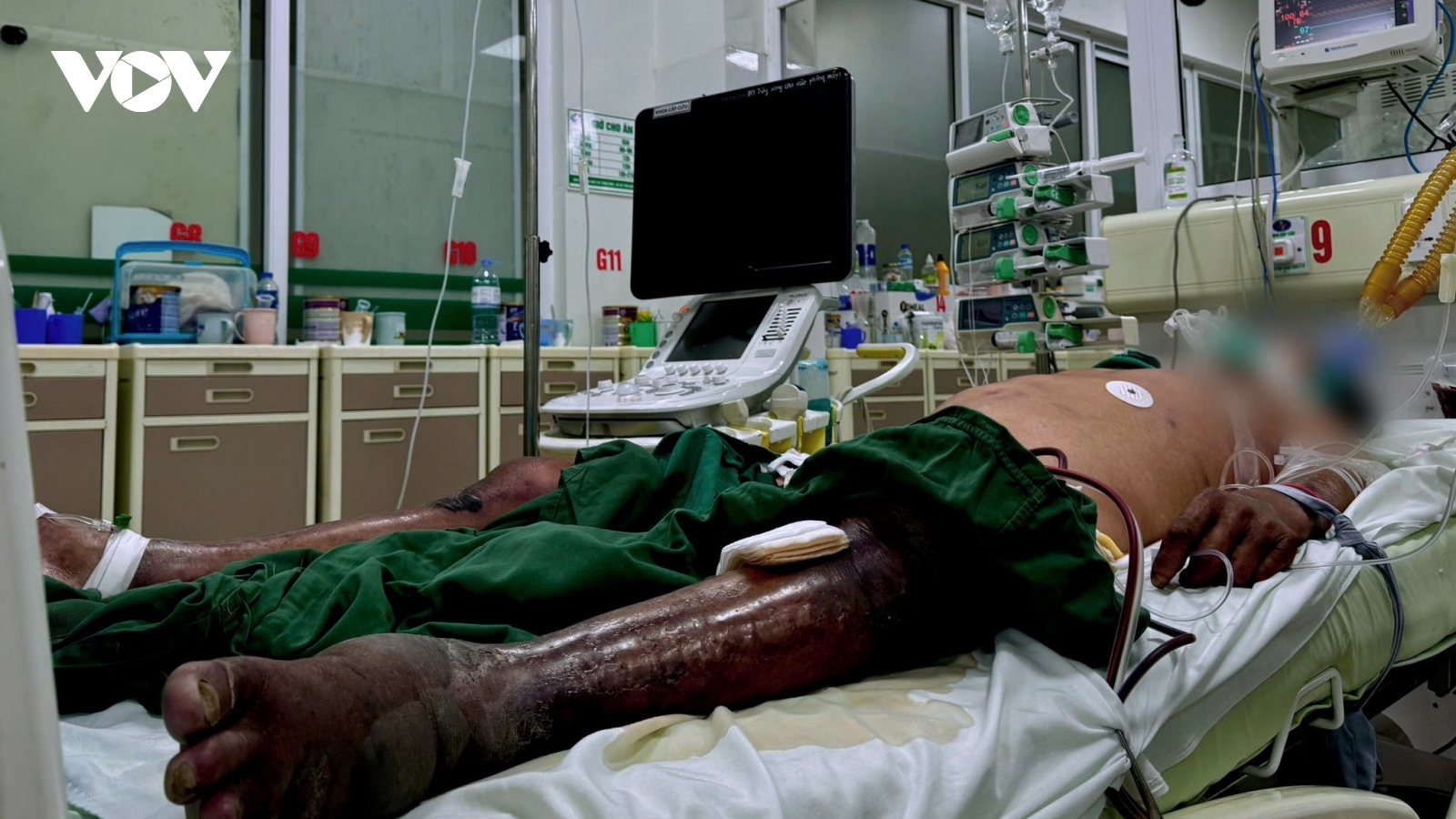 Người đàn ông hoại tử toàn bộ chân trái vì lý do tưởng chừng nhỏ nhặt