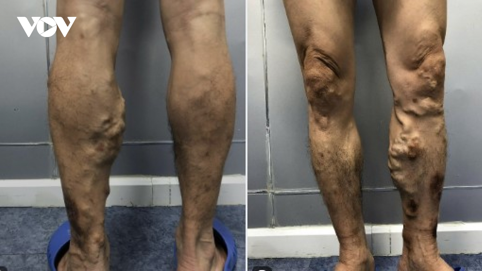 Căn bệnh mà Tổng thống Mỹ Donald Trump mắc nguy hiểm như thế nào?