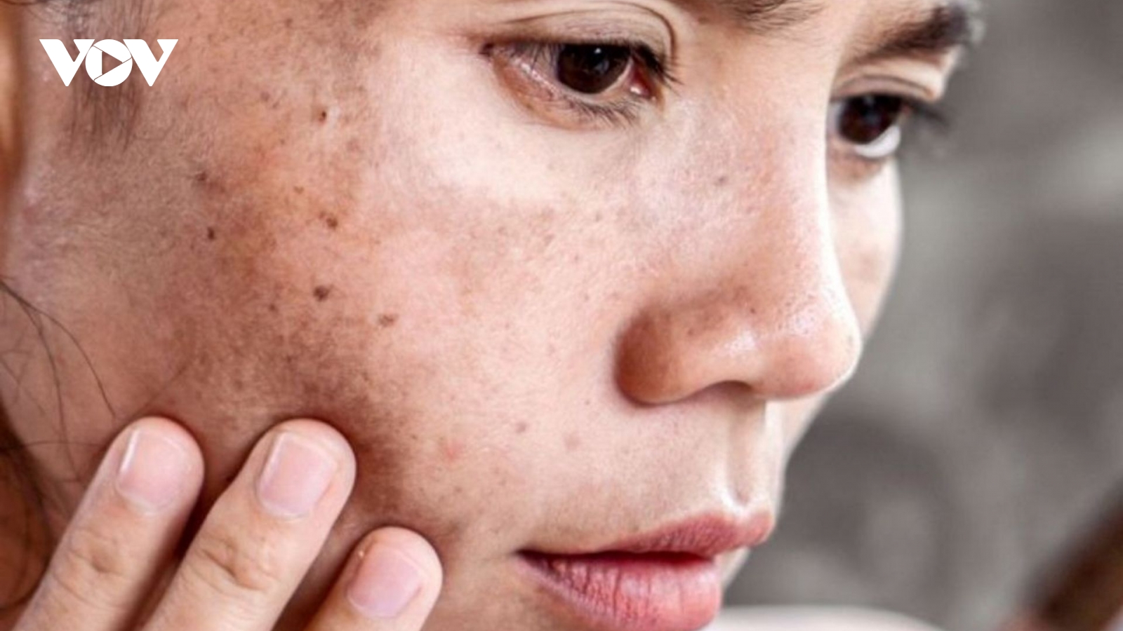 5 dấu hiệu cảnh báo gan đang suy yếu, thường hiện rõ trên mặt lại ít được chú ý