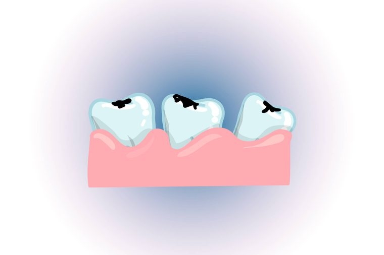Khiến răng nhạy cảm: Nhai đá lạnh còn khiến răng bị nứt mẻ, gây sâu răng và sưng đau cơ hàm. Chuyên gia cũng cảnh báo rằng nhai đá lạnh có thể khiến răng trở nên cực kỳ nhạy cảm, ê buốt khi ăn đồ nóng hoặc đồ lạnh.