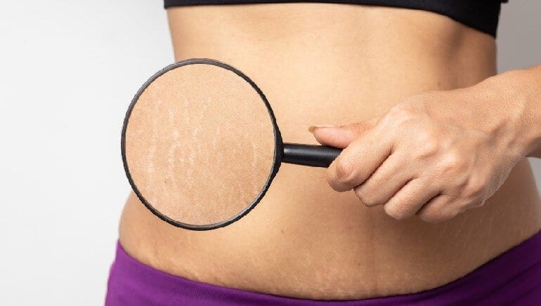 5. Ngăn ngừa rạn da: Trong thời kỳ mang thai, dầu dừa là một trong những loại dầu tốt nhất để ngăn ngừa rạn da. Do đặc tính chống viêm, dầu dừa có thể đẩy nhanh quá trình chữa lành vết rạn. Khả năng dưỡng ẩm sâu cho da của nó cũng giúp giảm ngứa ngáy ở những vết này. Bạn chỉ cần thoa một thìa dầu dừa lên vết rạn da và massage đến khi thấm hết. Để tránh bị rạn da, người ta khuyên các bà bầu nên thoa dầu dừa mỗi ngày./.