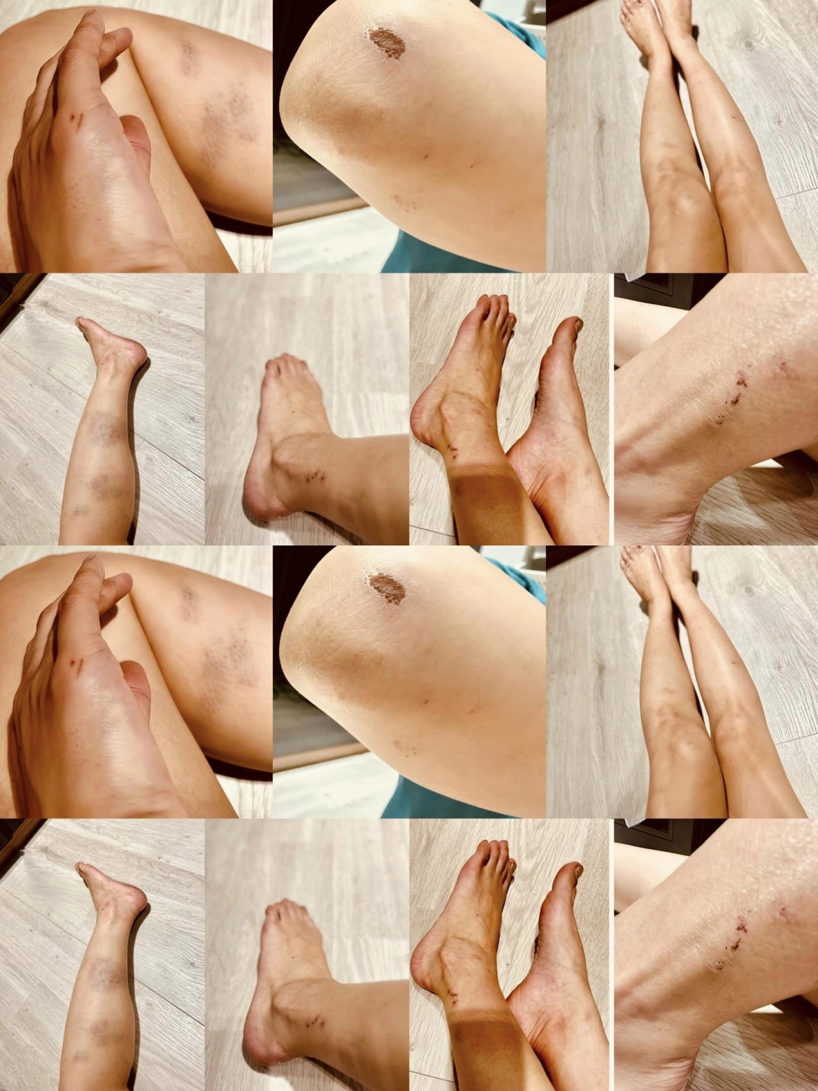 Thanh Hương chia sẻ hình ảnh những vết thương chi chít trên người cô. Nữ diễn viên luôn được đánh giá hết mình và đầy đam mê với mỗi vai diễn.