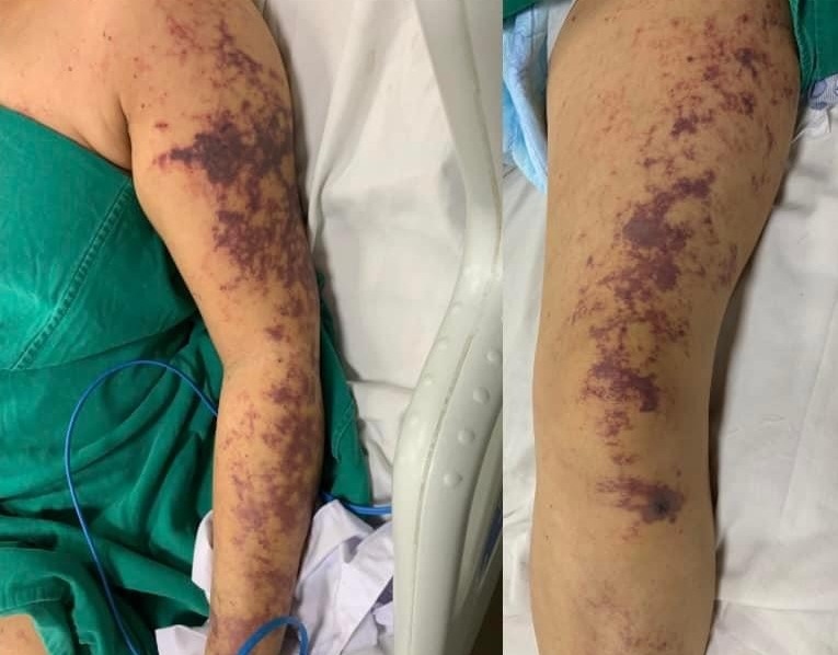 Nữ bệnh nhân mắc liên cầu lợn đang được điều trị tại Bệnh viện Bệnh Nhiệt đới T.Ư