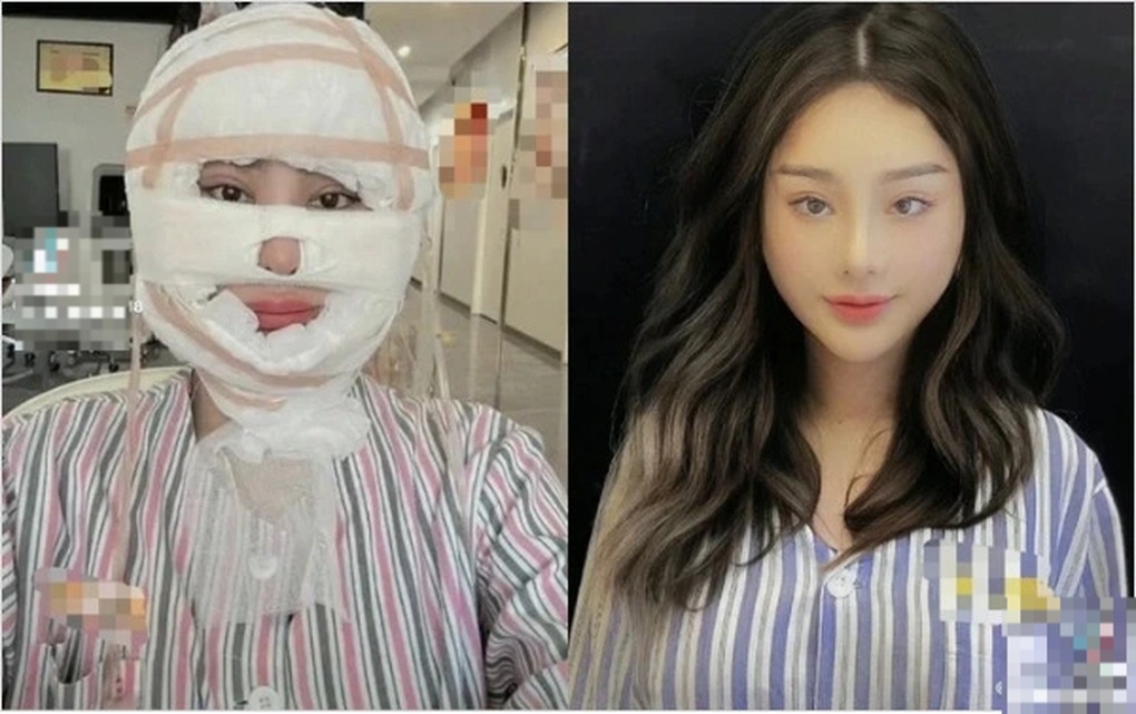 Vừa qua, hình ảnh được cho là Lâm Khánh Chi tiếp tục can thiệp "dao kéo" thu hút sự quan tâm của khán giả. Ngoài ra, ca sĩ chuyển giới còn đăng tải đoạn video băng bó kín mặt, kèm chia sẻ: "Hành trình của thanh xuân". Bên dưới video, nhiều người để lại bình luận khuyên người đẹp chuyển giới nên ngừng trùng tu nhan sắc để giữ gìn sức khỏe.