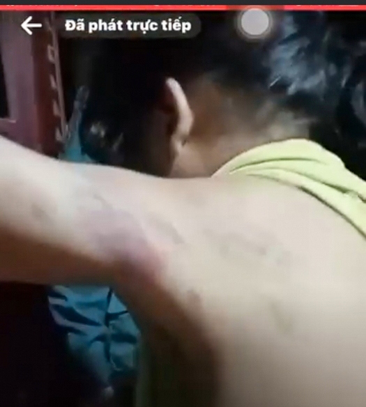 Phụ huynh phản ánh, cô giáo lớp 1C, Trường tiểu Khám Lạng đánh học sinh dẫn đến bầm tím bả vai