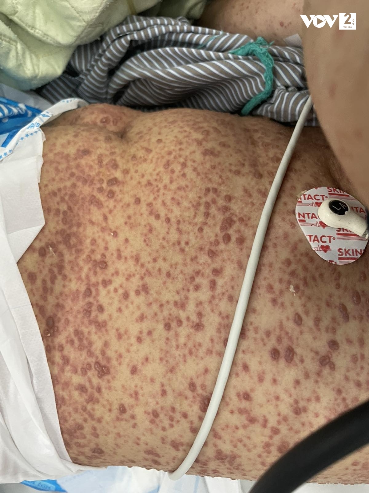 Hình ảnh tổn thương da do thủy đậu trên người bệnh nhân