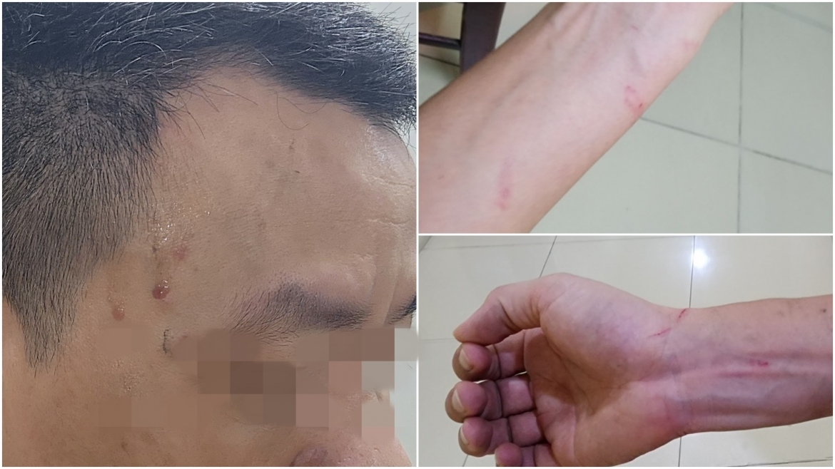 Hình ảnh vết thương trên người phóng viên