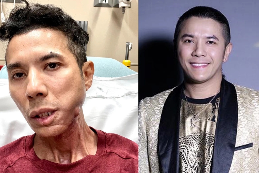 Hình ảnh hiện tại của Kasim Hoàng Vũ (trái) khiến nhiều người xót xa