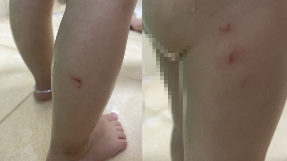 Những vết bấm móng tay chi chít ở trên người bé Huy