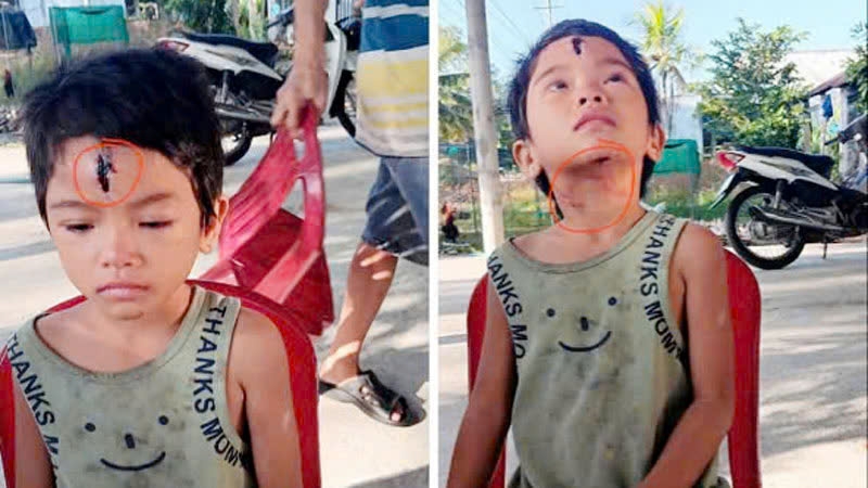 Thương tích trên người bé Ng T. N được một người thầy giáo chia sẻ trên mạng xã hội. Ảnh: Facebook