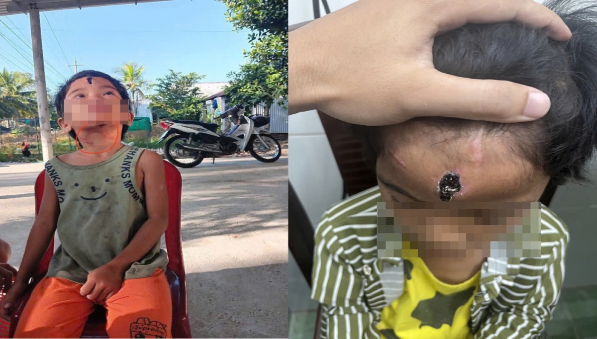 bé Ng T. N (6 tuổi) với những vết thương do cha dượng bạo hành