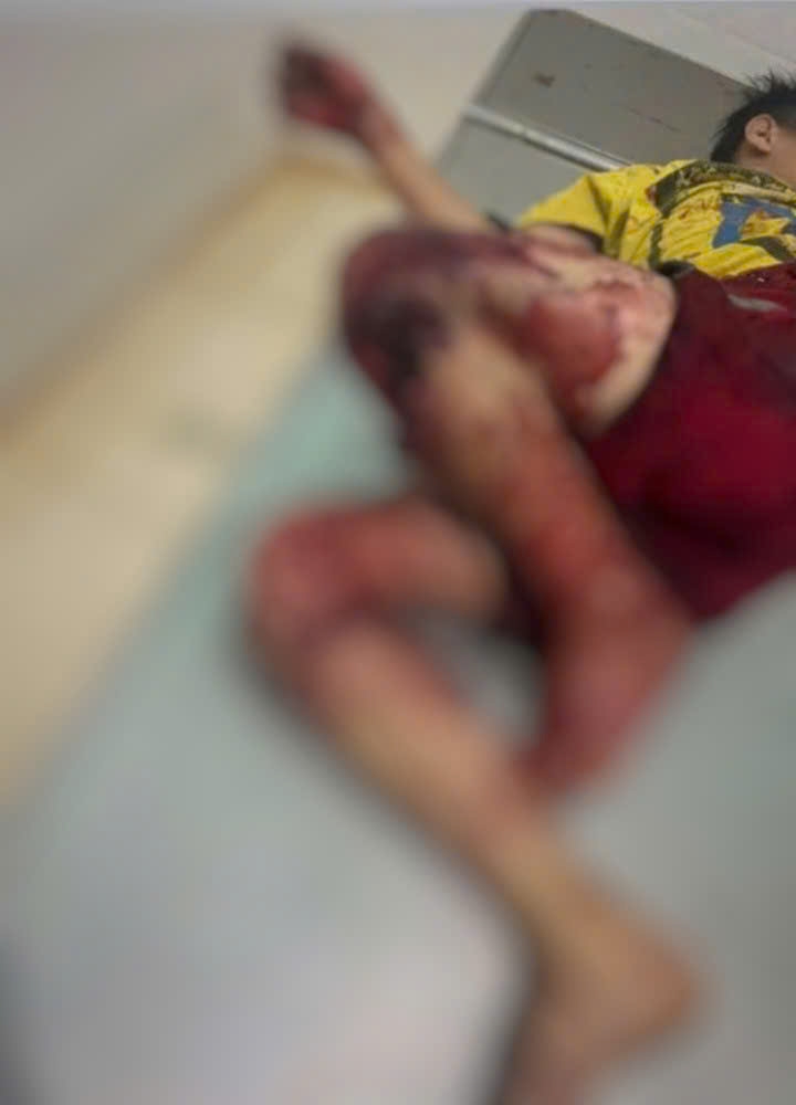 Một trong 4 học sinh bị thương khi chế tạo pháo nổ tại nhà