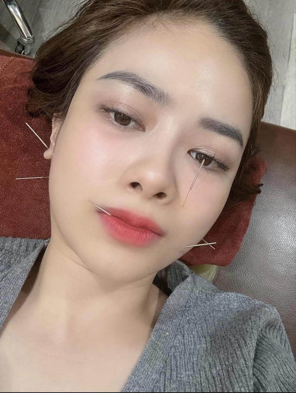 Dương Hoàng Yến châm cứu vì bị liệt dây thần kinh số 7 ngoại biên.