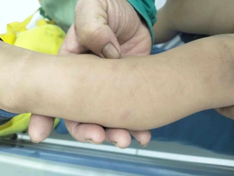 Các vết bầm trên cánh tay của trẻ