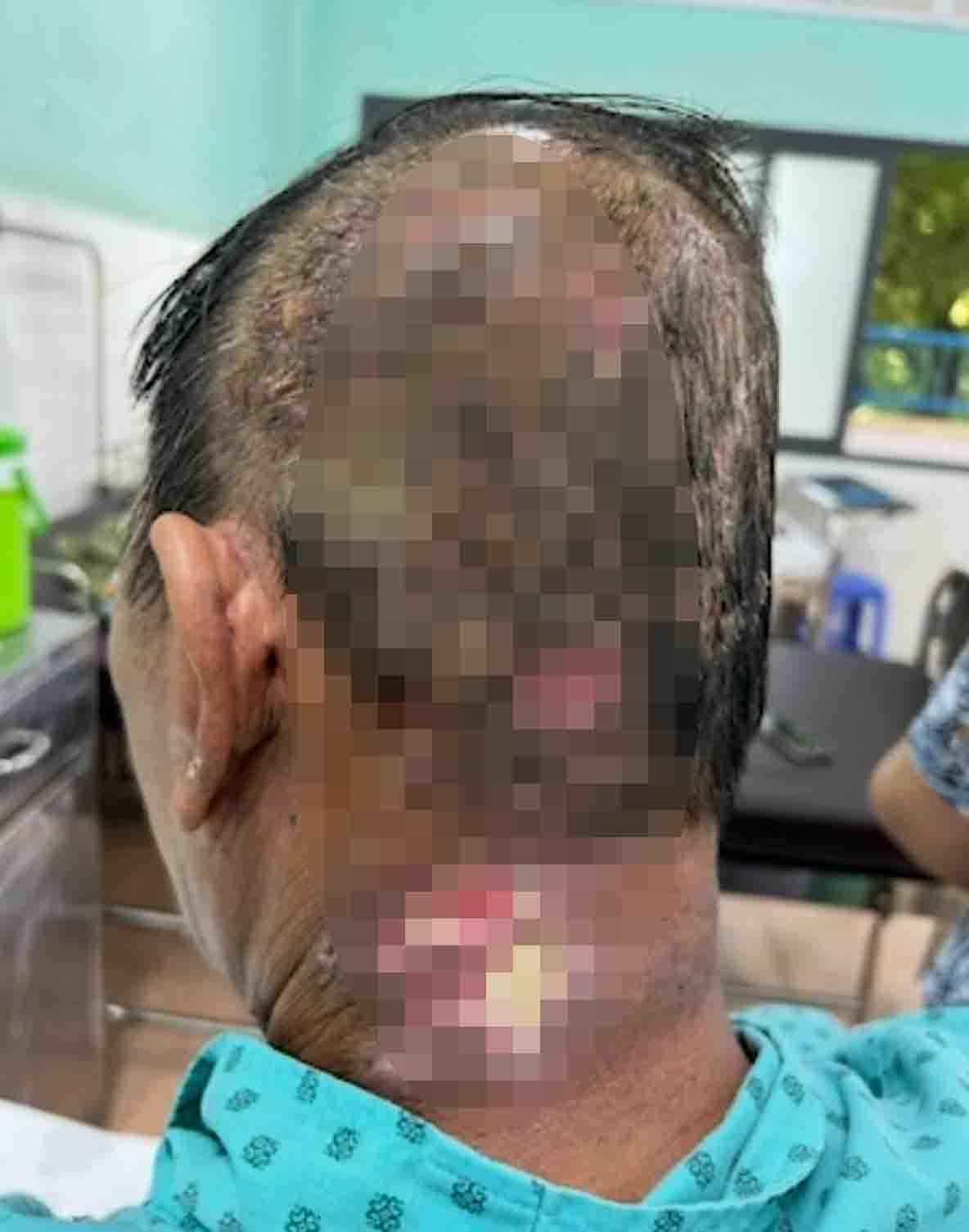 Một trường hợp biến chứng nghiêm trọng do tự ý điều trị, tìm "thầy khoán" (Ảnh BV cung cấp)