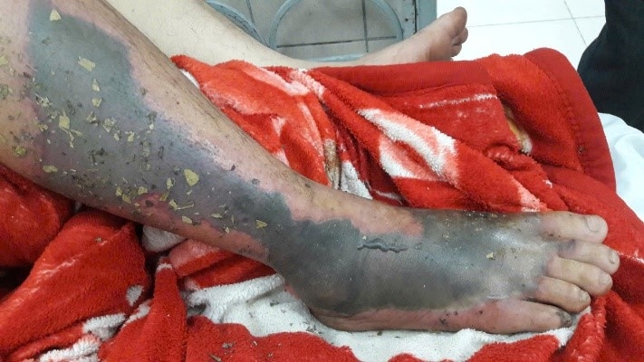 Các bệnh nhân rắn độc cắn tự dùng thuốc YHCT tại nhà, đến viện muộn khi đã nhiễm độc nặng, hoại tử rộng chân tay