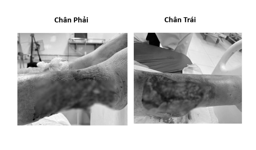 Vết thương có nguy cơ hoại tử sau tai nạn giao thông
