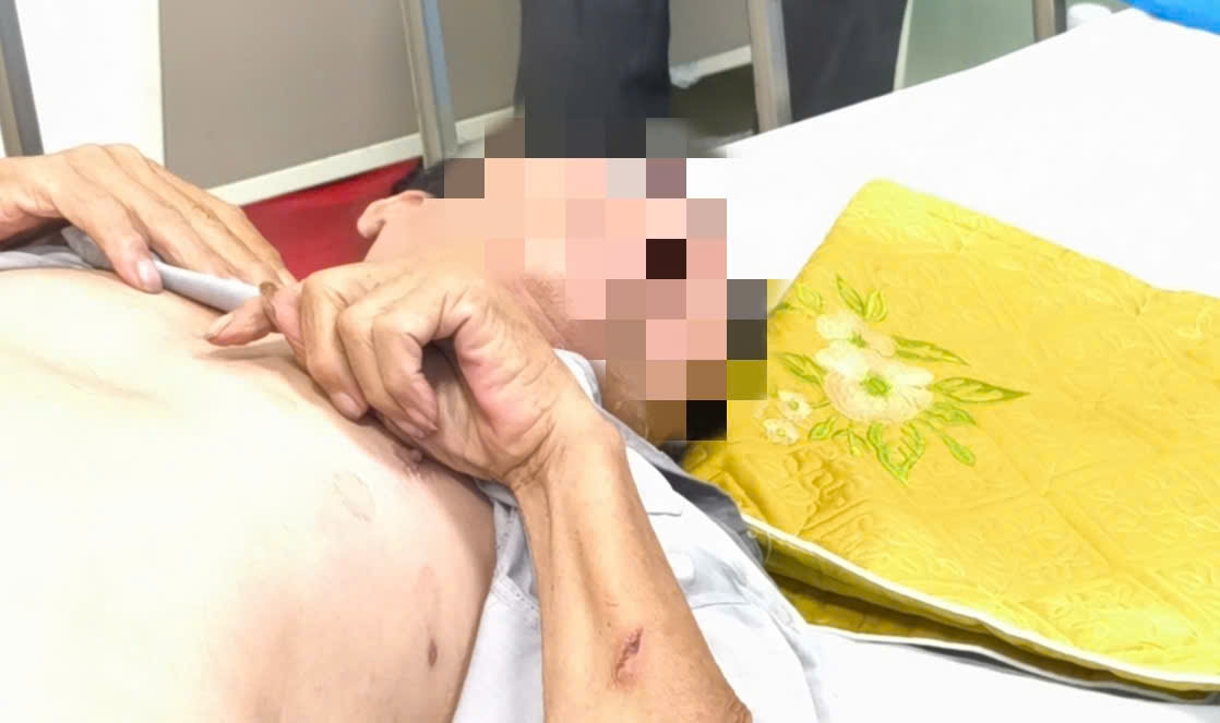 Bị chó cắn nhiều lần không tiêm phòng, người đàn ông nguy kịch vì bệnh dại